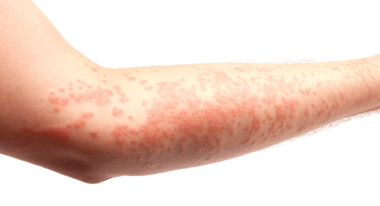 Das richtige Waschmittel für Allergiker - bluu - Die Waschsensation