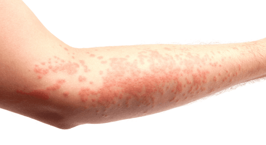 Das richtige Waschmittel für Allergiker - bluu - Die Waschsensation